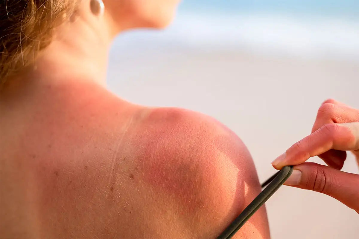 sonnenbedingte hautrötung eine natürliche Reaktion